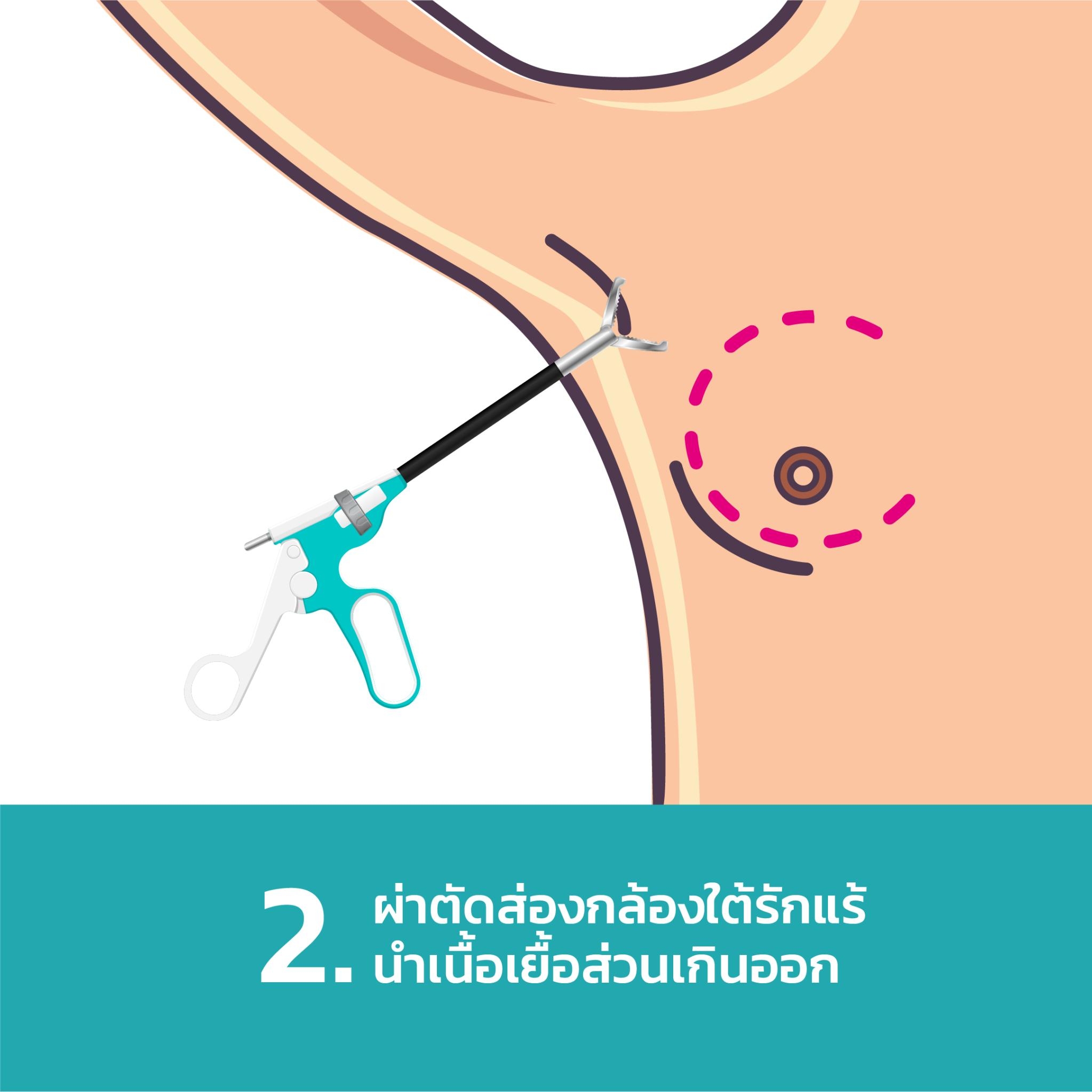 ขั้นตอน ตัดนมทอม ส่องกล้องใต้รักแร้