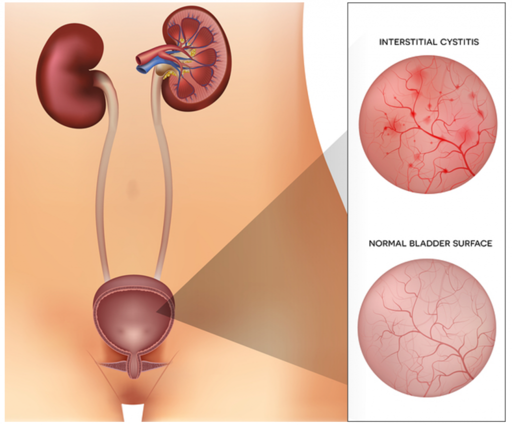 การรักษา อาการกระเพาะปัสสาวะอักเสบ (Cystitis)