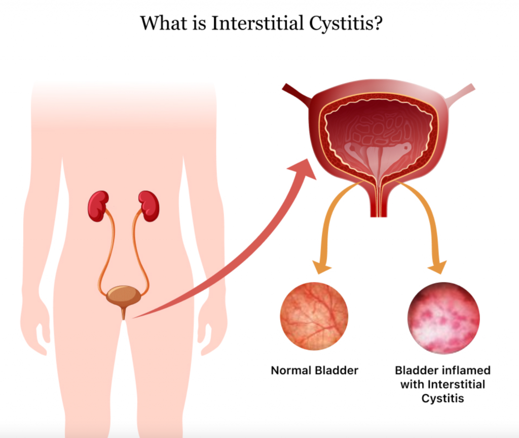 กระเพาะปัสสาวะอักเสบ (Cystitis) รักษาอย่างไร