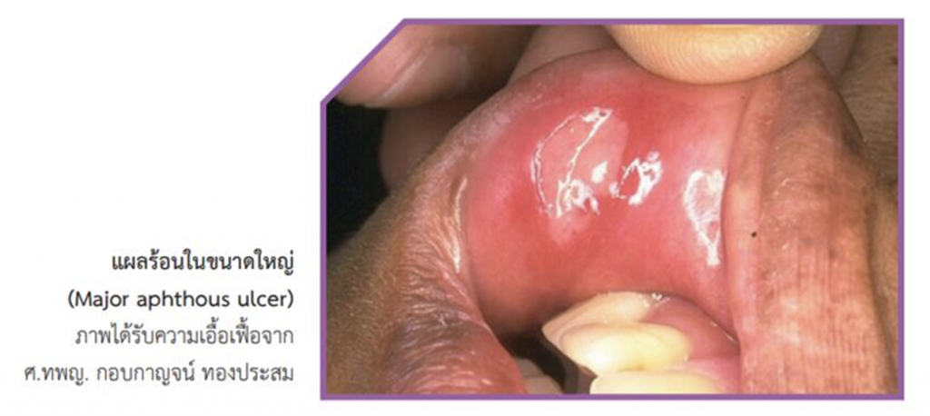 ร้อนใน แผลในช่องปาก ขนาดกลาง