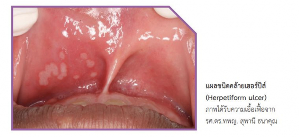 ร้อนใน แผลในช่องปาก ขนาดใหญ่