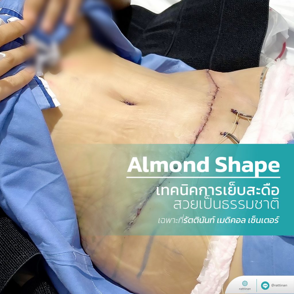 ตกแต่งสะดือ Almond Shape หลังการผ่าตัดหนังหน้าท้อง (Tummy Tuck)