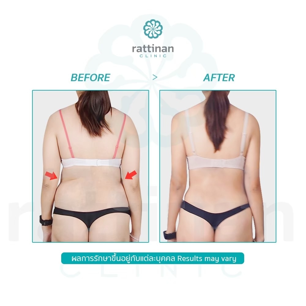 รีวิว ดูดไขมันเอว waist liposuction