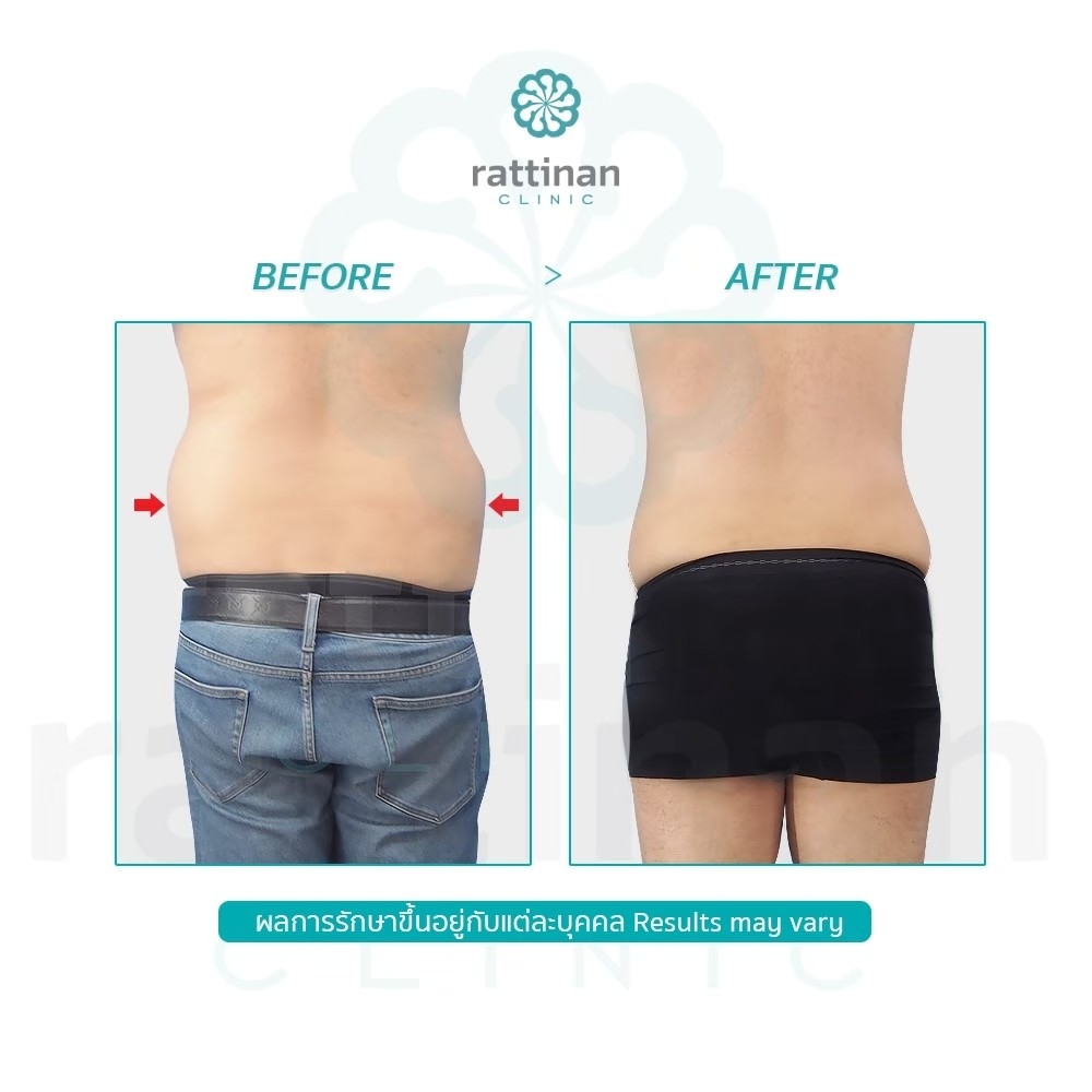 รีวิว ดูดไขมันเอวผู้ชาย BodyTite 5