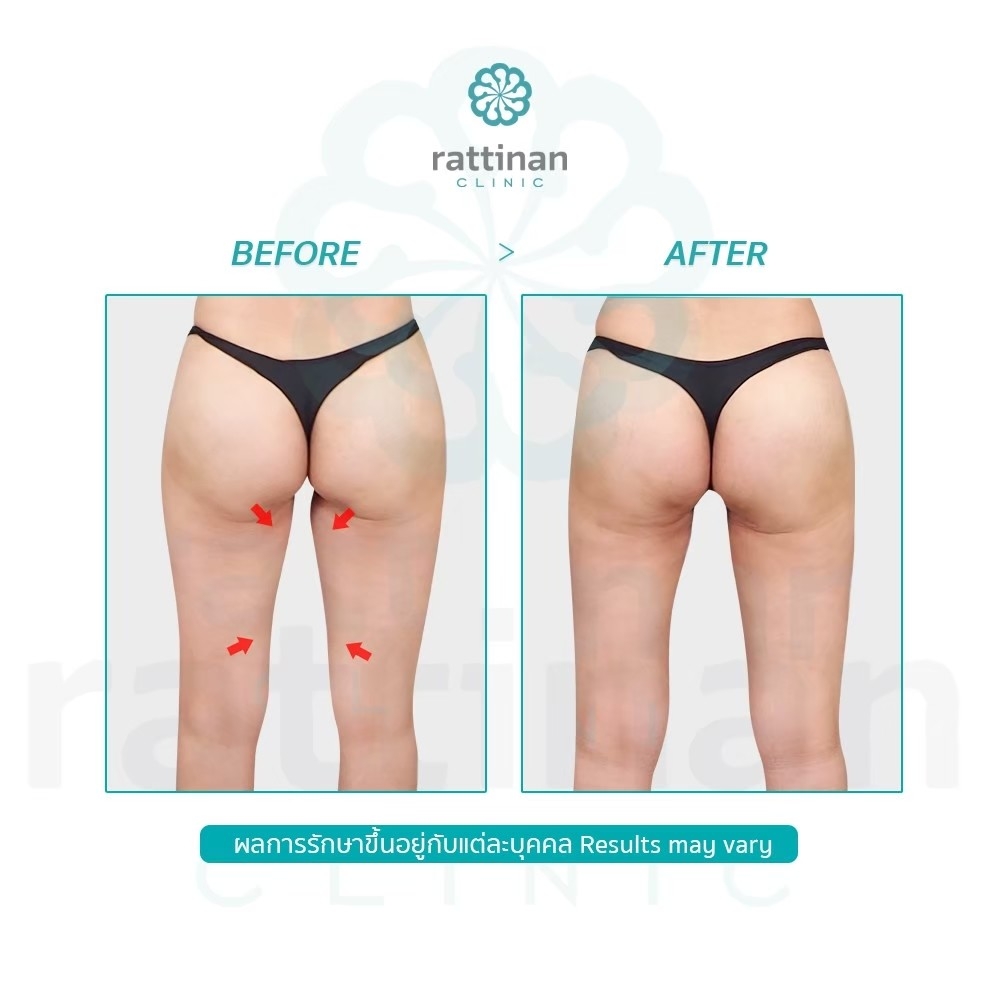 รีวิว ดูดไขมันขาใน - bodyTite liposuction