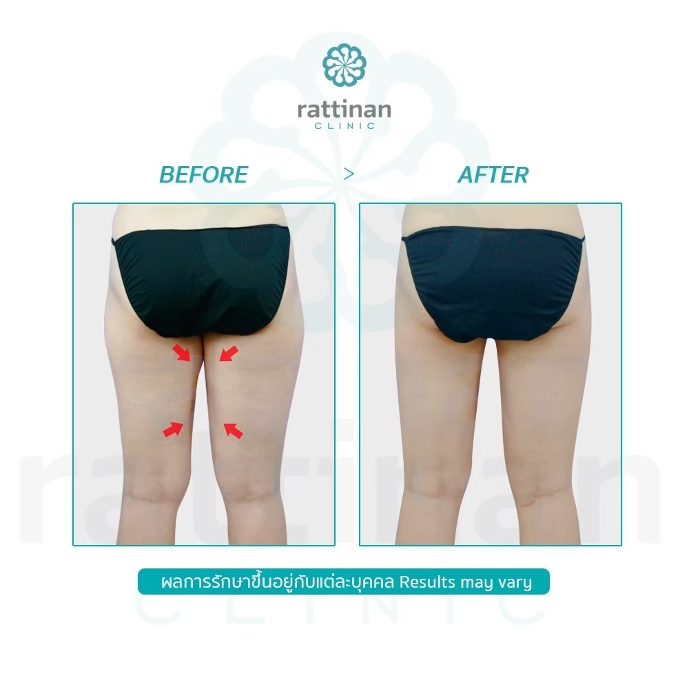 ดูดไขมันขา ลดไขมันต้นขาด้านใน ขาใหญ่ ขาเบียด ด้วย bodyTite liposuction