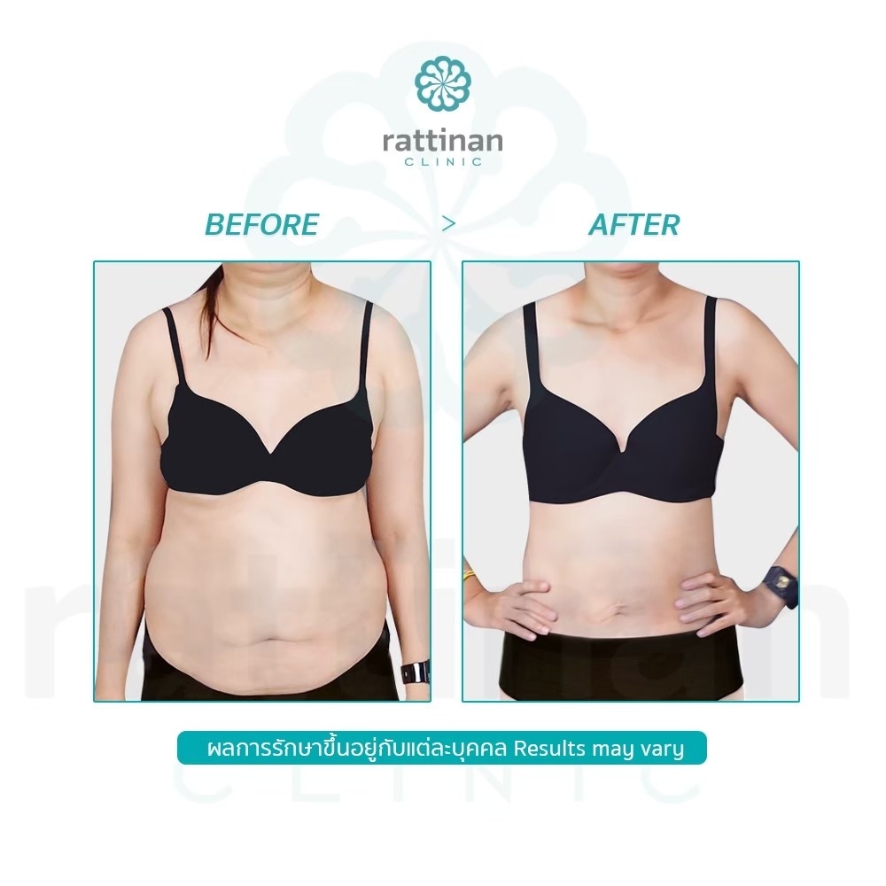 ลดไขมันส่วนเกินหน้าท้อง แก้ได้โดยการดูดไขมัน BodyTite liposuction