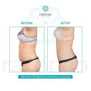 ดูดไขมันหน้าท้อง ท้องย้วย Bodytite Liposuction