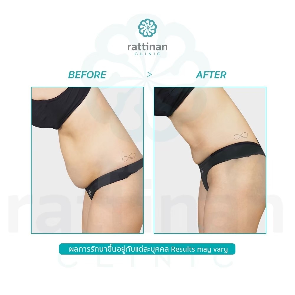 ลดหน้าท้อง ดูดไขมันหน้าท้อง Bodytite Liposuction