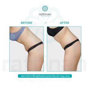 ดูดไขมันหน้าท้อง วิธีลดไขมันส่วนเกินหน้าท้อง ด้วย BodyTite liposuction