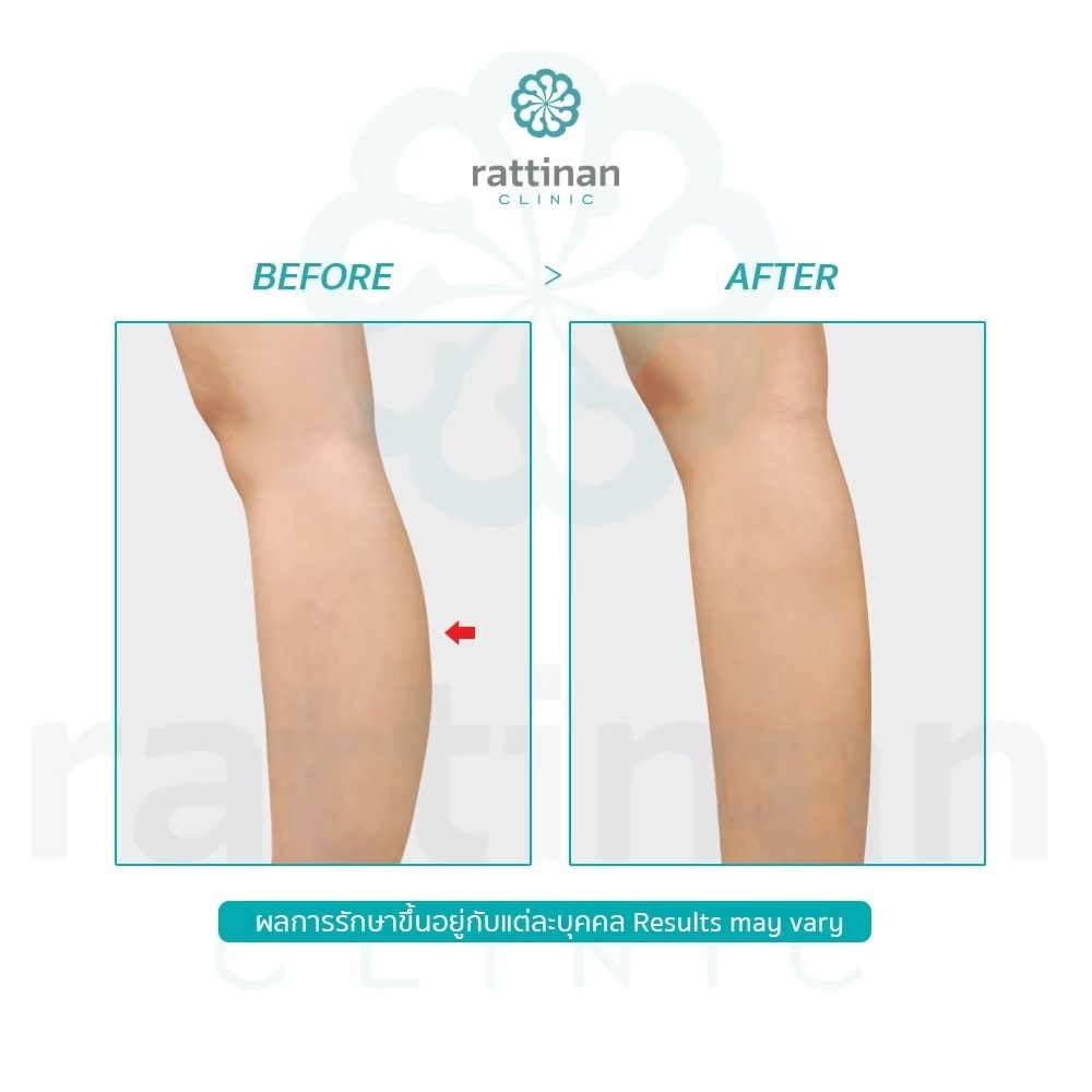 รีวิว ดูดไขมันน่อง ลดน่องโต Bodytite + microaire PAL