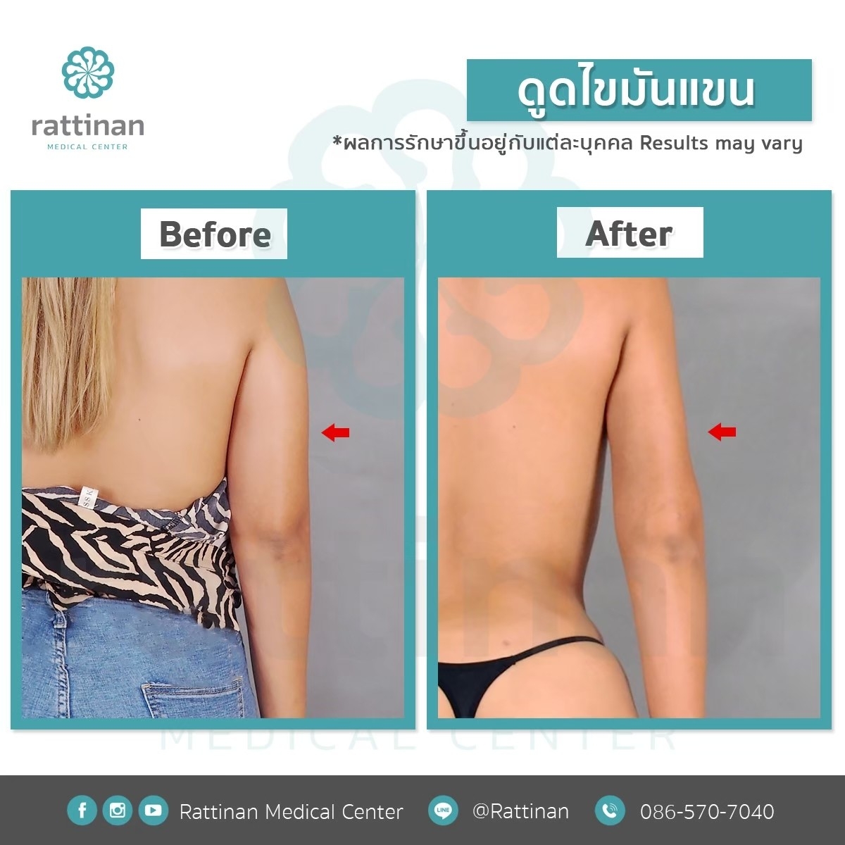 รีวิวดูดไขมันต้นแขน BodyTite + mocroaire PAL 5