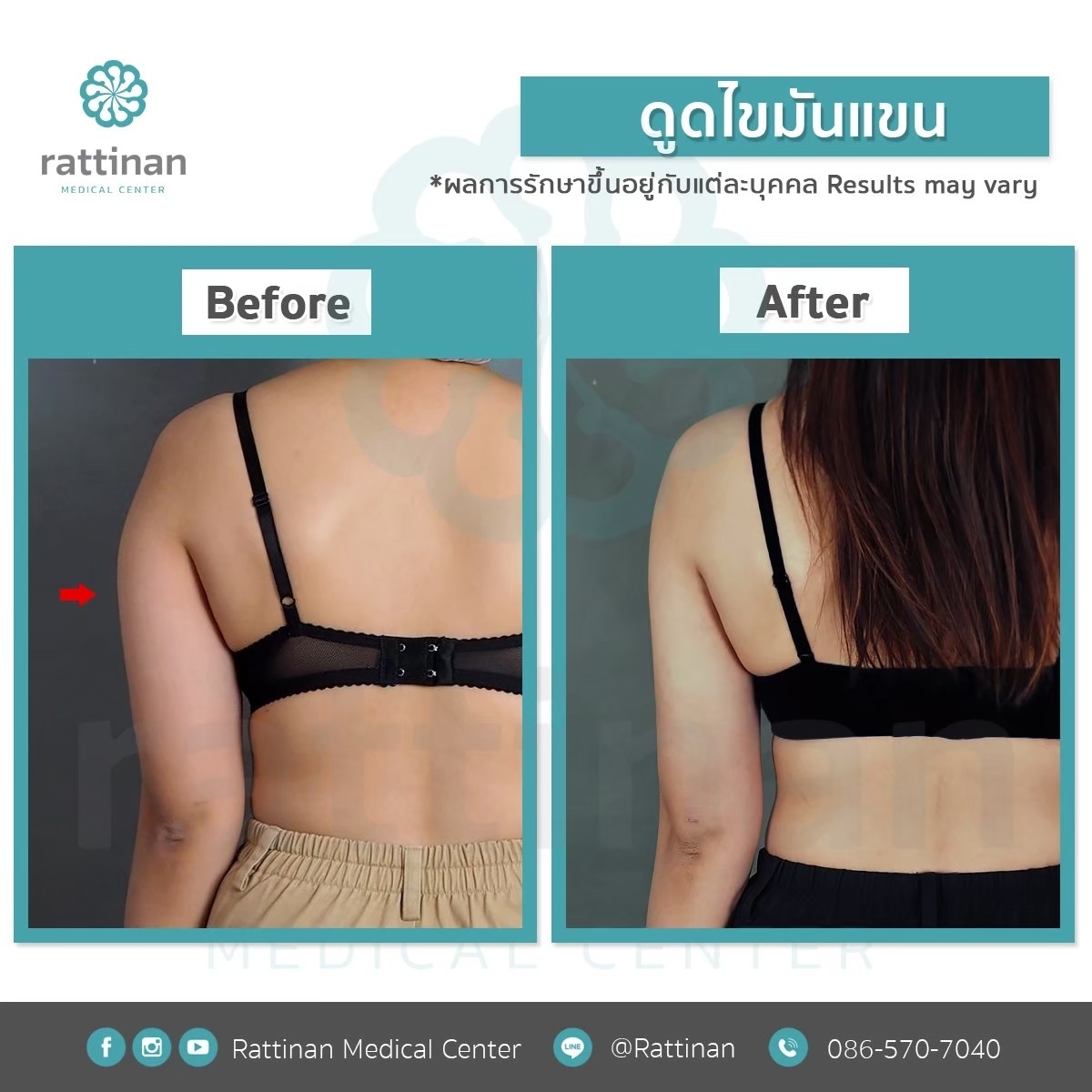 รีวิวดูดไขมันต้นแขน BodyTite + mocroaire PAL 4