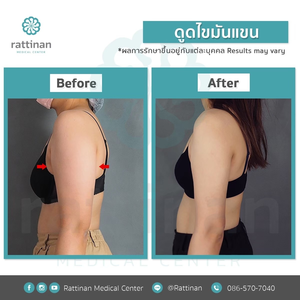 รีวิวดูดไขมันต้นแขน BodyTite + mocroaire PAL 3