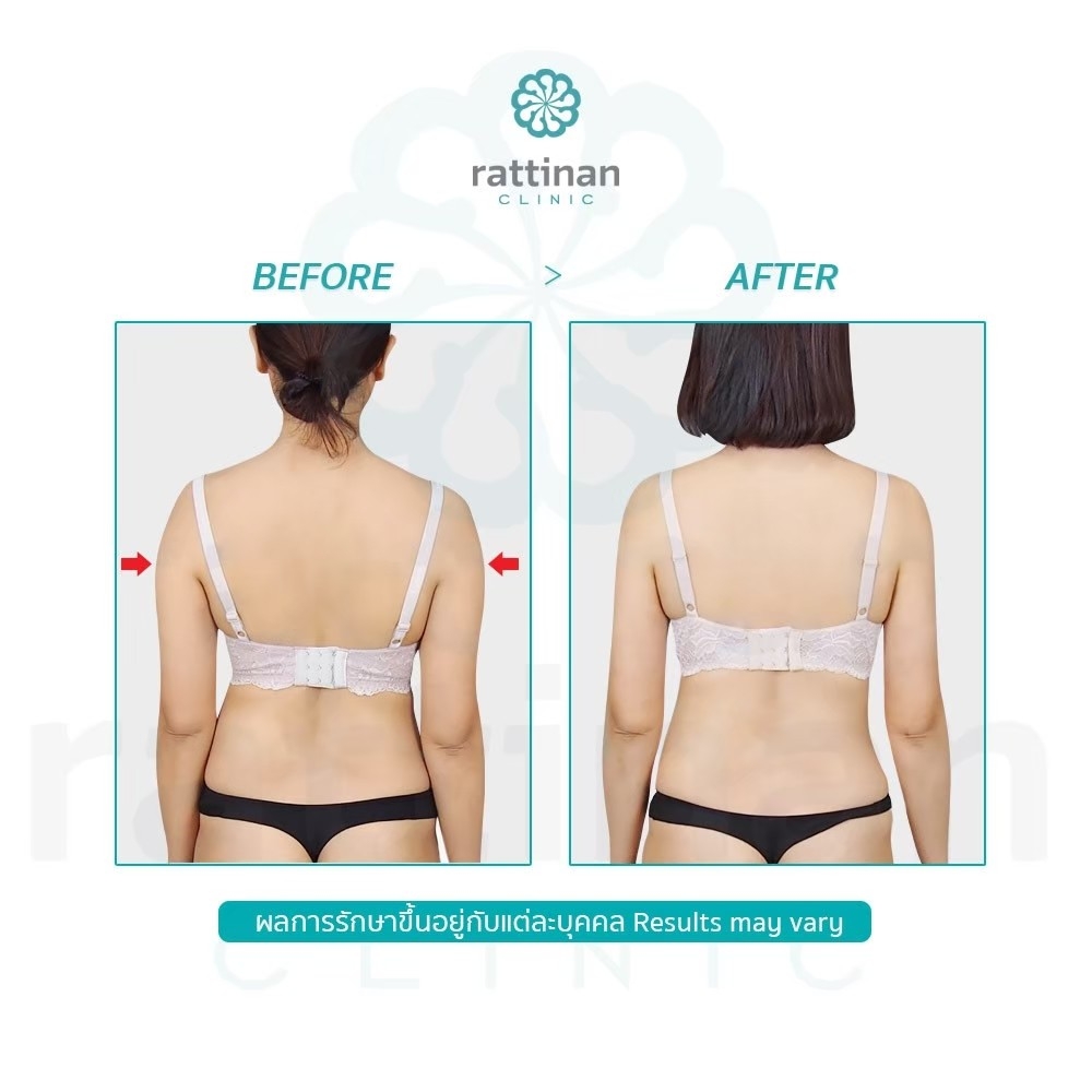 รีวิวดูดไขมันต้นแขน BodyTite + mocroaire PAL 10