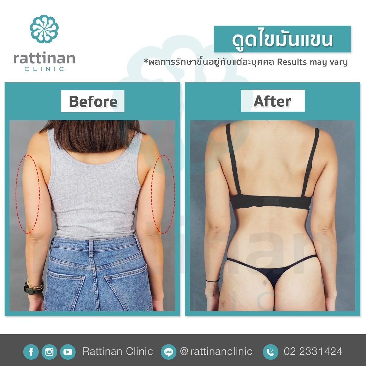 รีวิวดูดไขมันต้นแขน BodyTite + mocroaire PAL 2