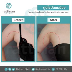 รีวิวดูดไขมันน้อย ก้อนใต้รักแร้ คืออะไร รักษาอย่างไร 3