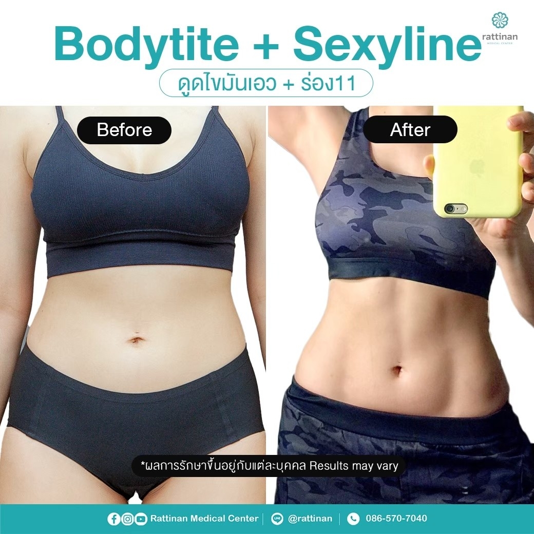 รีวิว ดูดไขมันเอว เอวเอส เอวคอด BodyTite + PAL 4