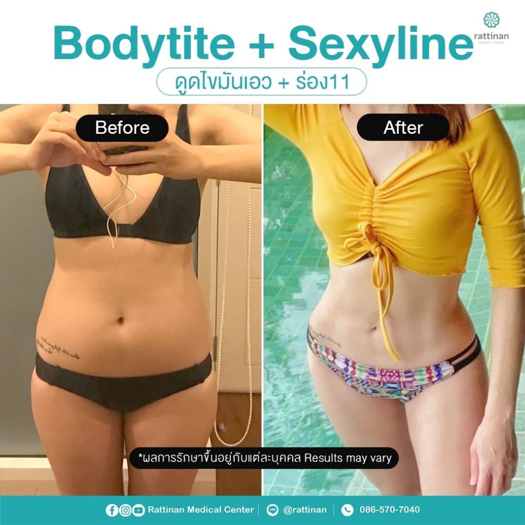 รีวิว ดูดไขมันเอว เอวเอส เอวคอด BodyTite + PAL 5