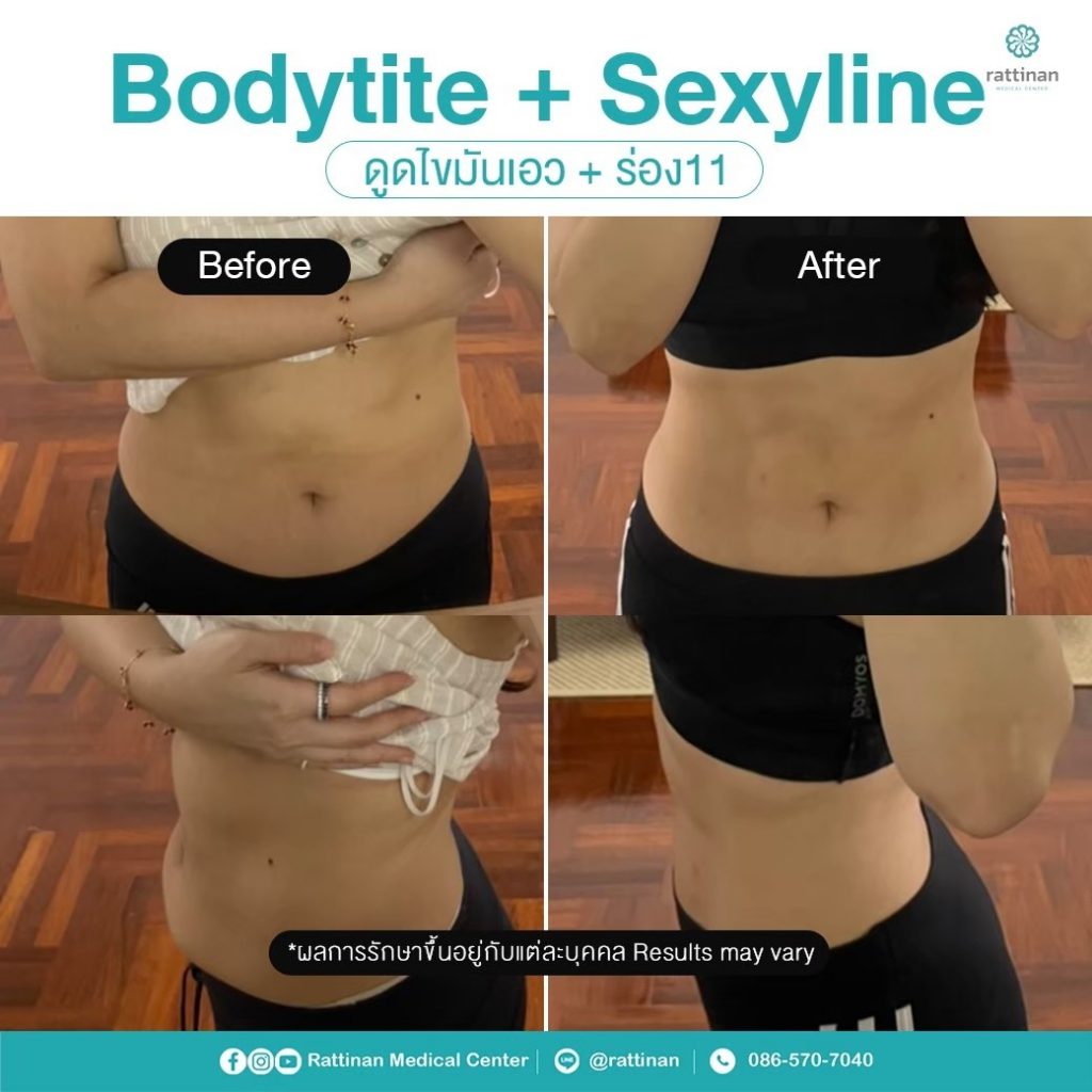 รีวิว ดูดไขมันเอวเอส Sexy line ร่อง11 BodyTite