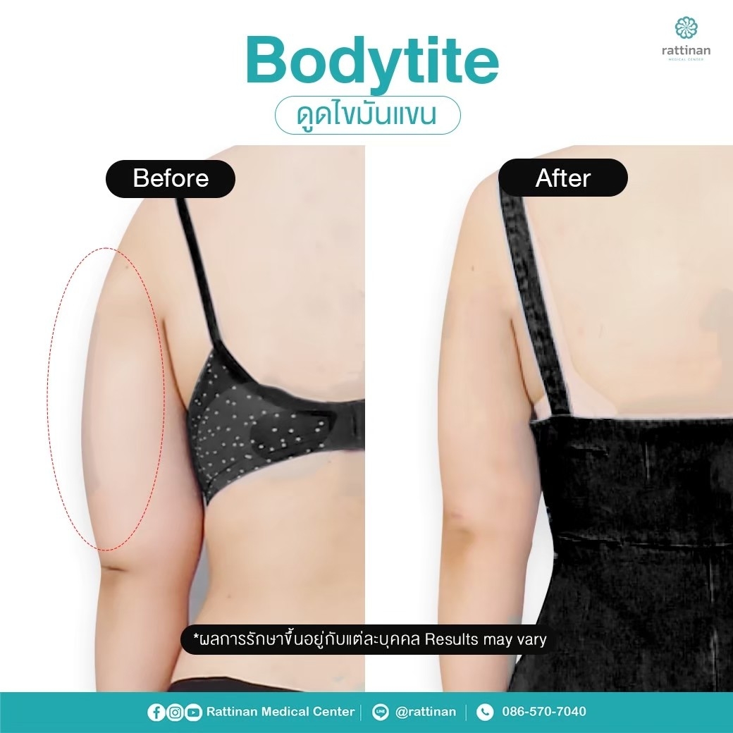 วิธีลดไขมันแขน ดูดไขมันต้นแขน ด้วย BodyTite + microAire PAL