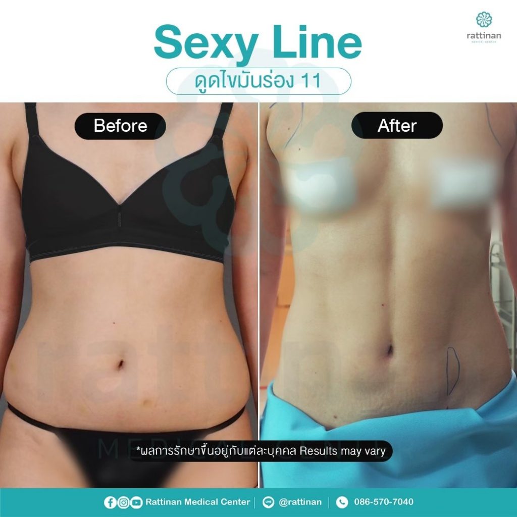 รีวิว sexy line ดูดไขมันร่อง 11