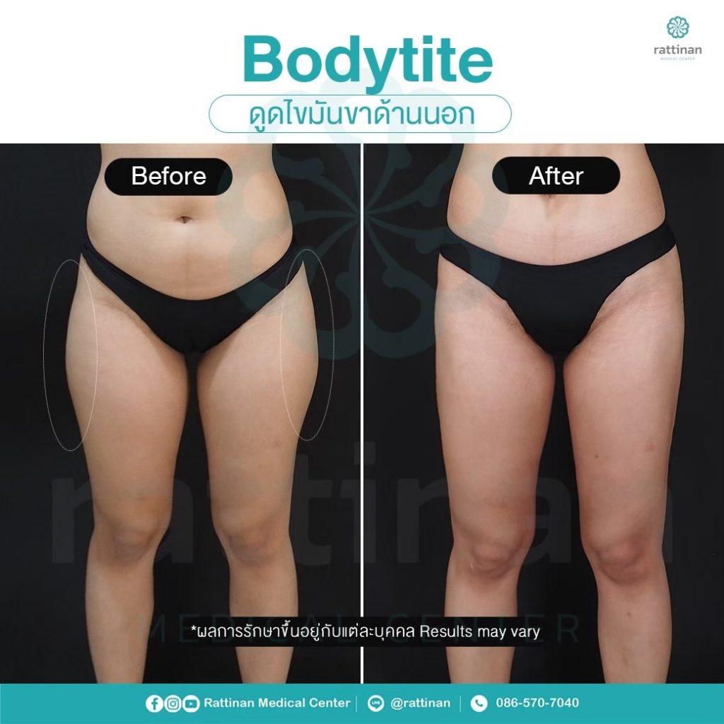 ดูดไขมันขา ลดไขมันต้นขาด้านนอก ด้วย bodyTite liposuction