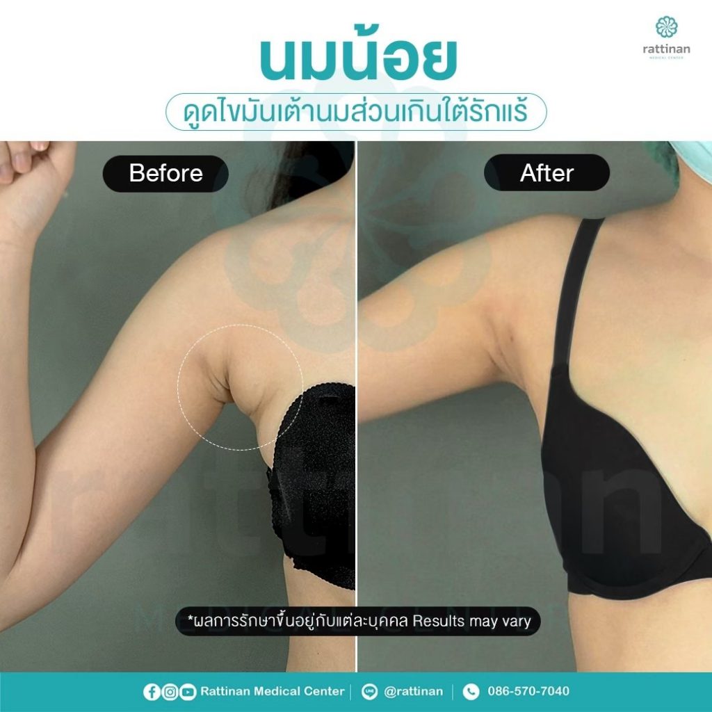 รีวิวดูดไขมันน้อย ก้อนใต้รักแร้ คืออะไร รักษาอย่างไร 4