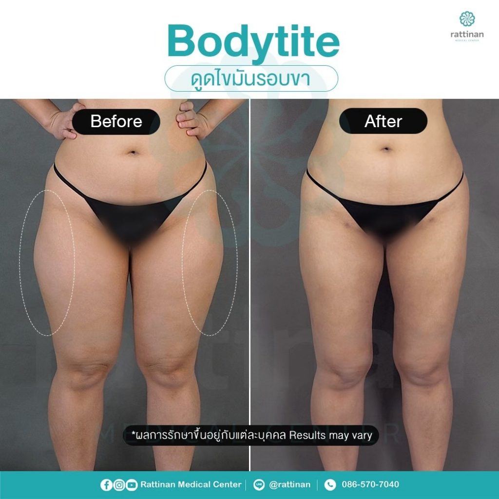 ดูดไขมันขา ลดต้นขาใหญ่ ด้วย bodyTite liposuction