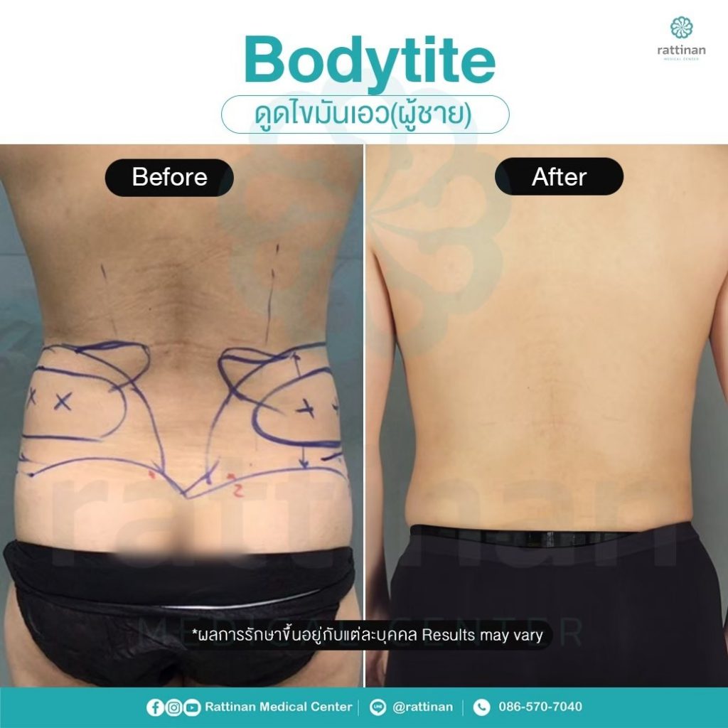 รีวิว ดูดไขมันเอวผู้ชาย BodyTite