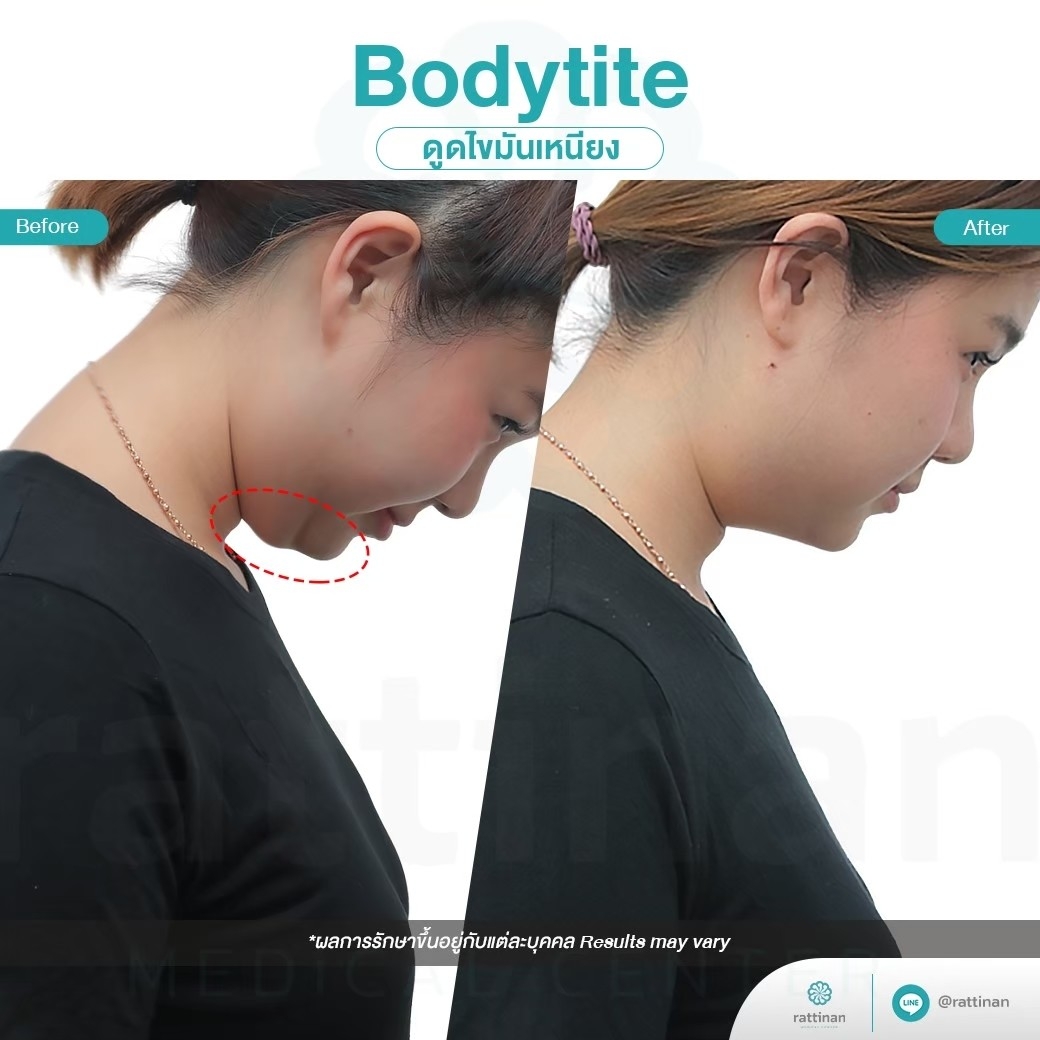 ดูดไขมันเหนียง คาง ด้วยเครื่อง BodyTite