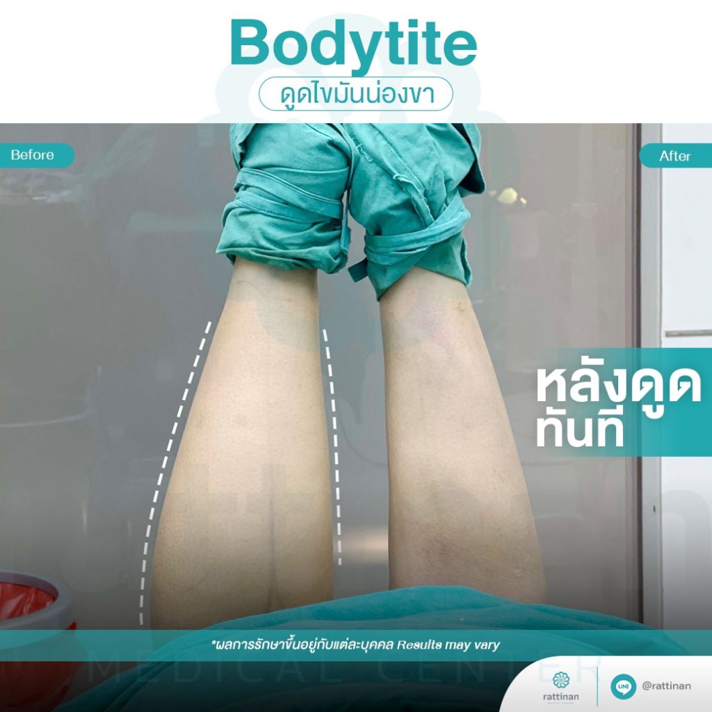 ดูดไขมันน่อง ลดน่องโต Bodytite + microaire PAL