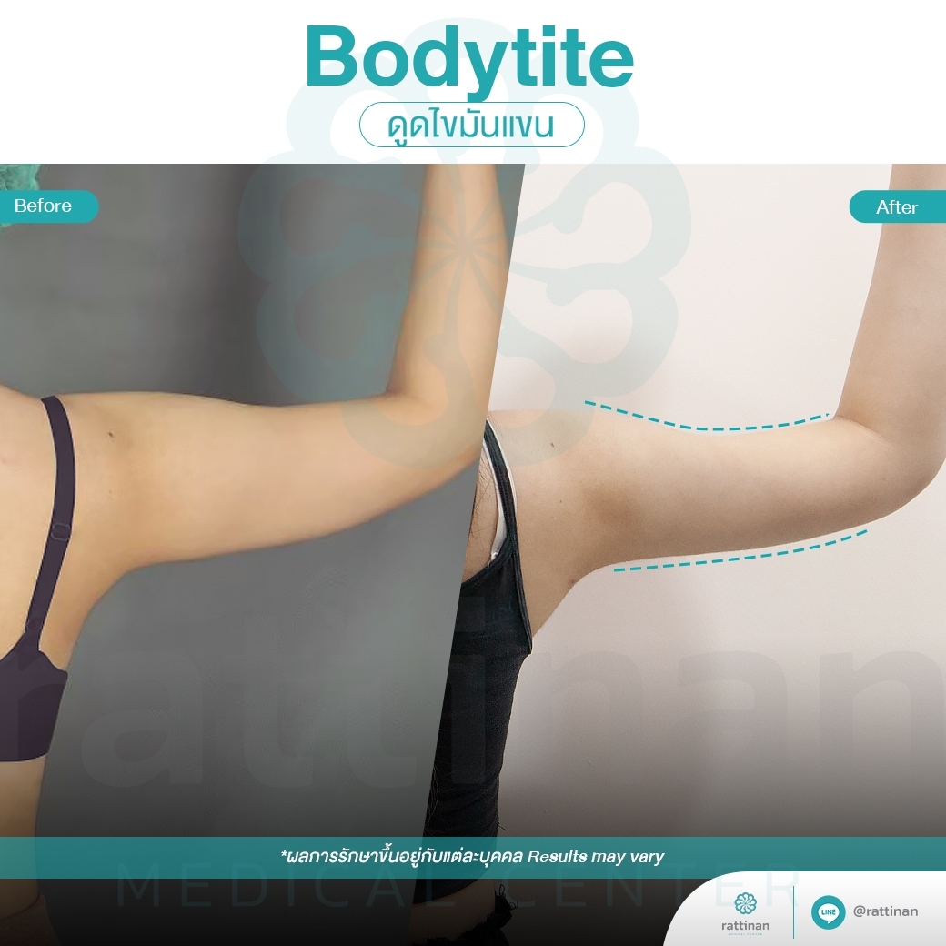 ลดไขมันต้นแขน ด้วยเครื่องดูดไขมัน Bodytite + microaire PAL