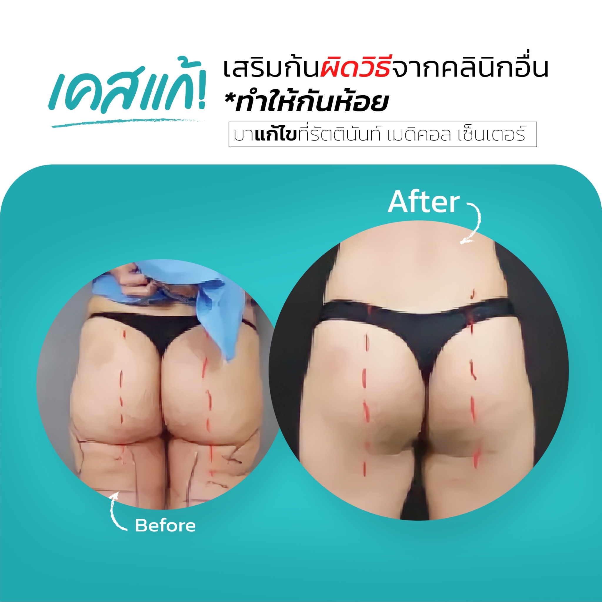 รีวิวเคสแก้เสริมสะโพก จากคลินิกอื่น เสริมสะโพกผิดวิธี