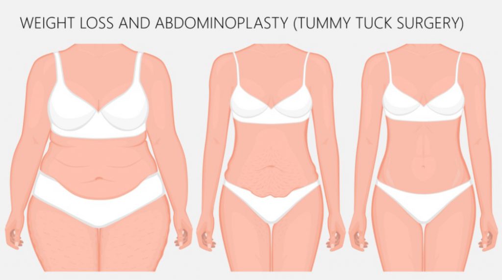 ตัดหน้งหน้าท้อง เหมาะกับใคร - tummy tuck