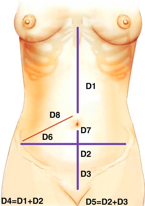 ตำแหน่งสะดือ หลังผ่าตัดหนังหน้าท้อง - tummy tuck