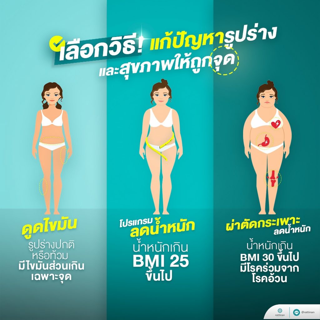 เลือกวิธีแก้ปัญหารูปร่างและสุขภาพ ดูดไขมัน ผ่าตัดกระเพาะ