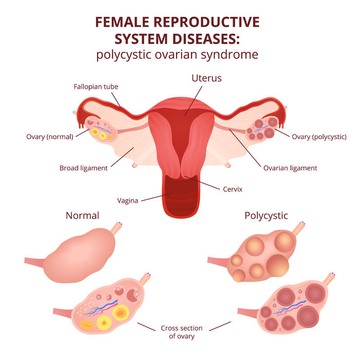 4. ถุงน้ำหลายใบในรังไข่ (Polycystic Ovary Syndrome)