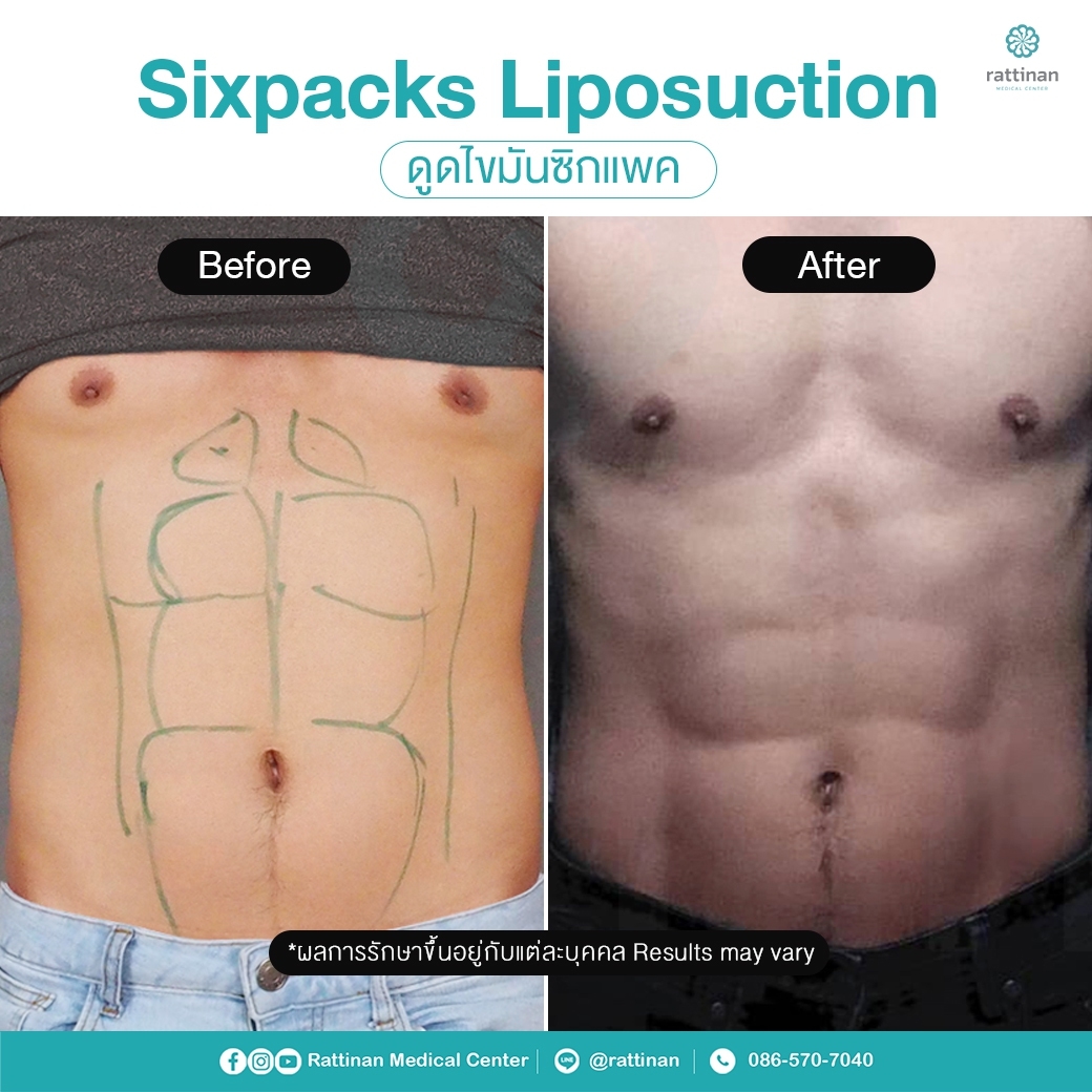 รีวิว ดูดไขมันซิกแพค - six pack liposuction ที่รัตตินันท์ เมดิคอล เซ็นเตอร์