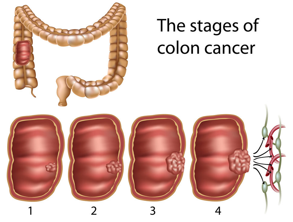 ระยะของ มะเร็งลำไส้ใหญ่