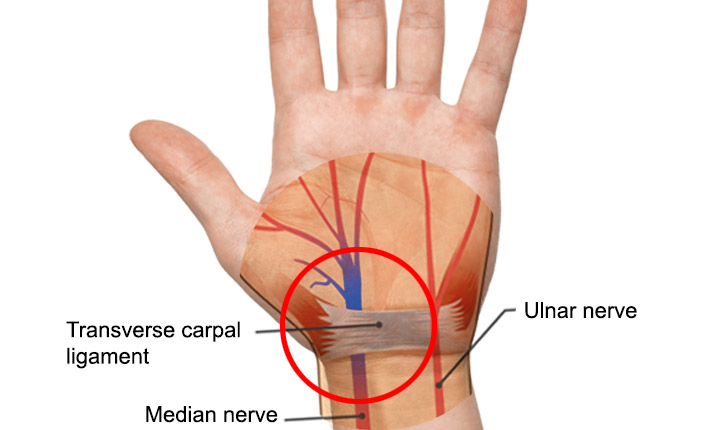 พังผืดโพรงฝ่ามือกดทับเส้นประสาท (Carpal tunnel Syndrome) อันตรายอย่างไร