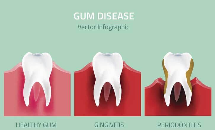 ประเภทของ โรคเหงือก
