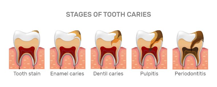 อาการ ฟันผุ รักษาอย่างไรดี