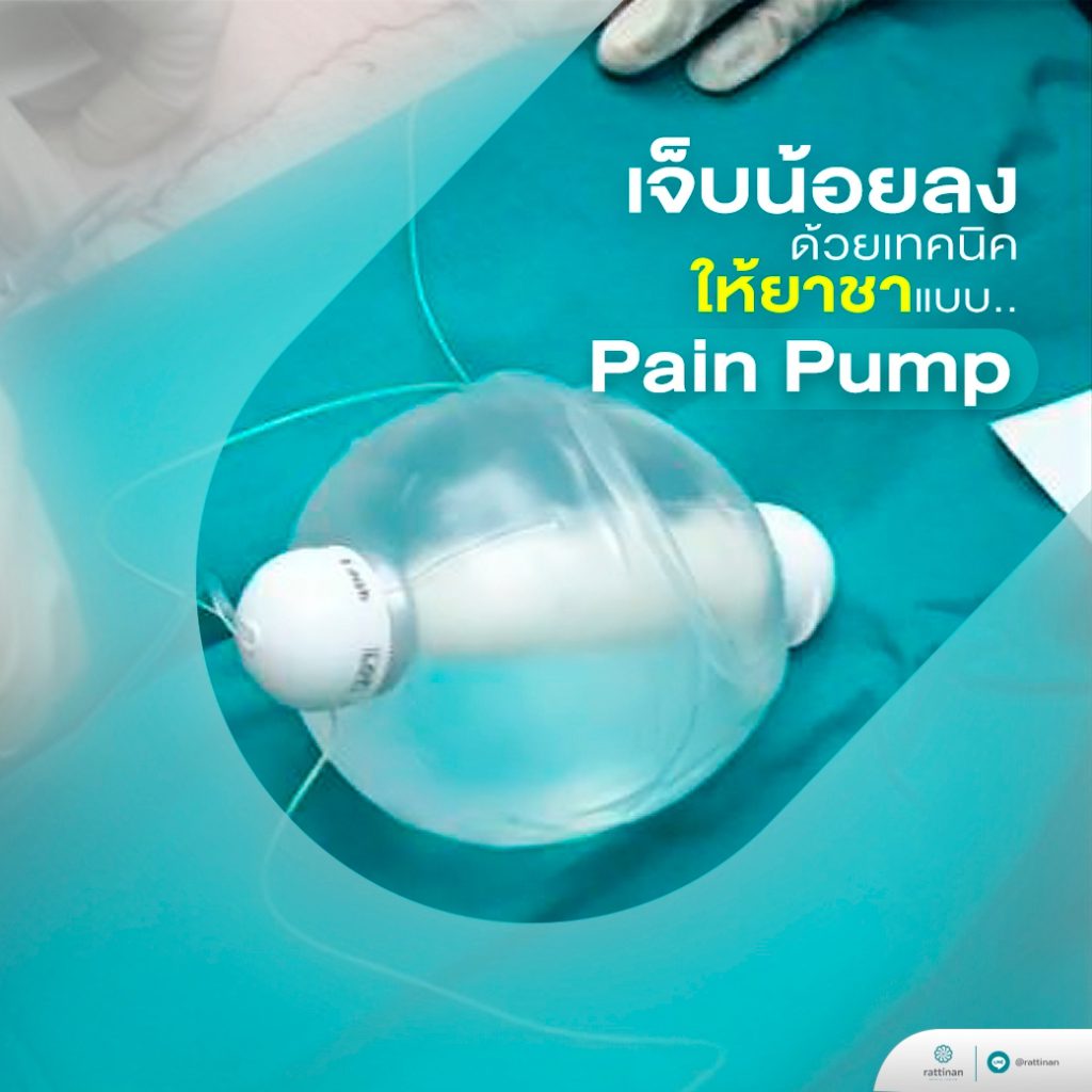 เจ็บน้อยลงด้วยเทคนิคให้ยาชาแบบ Pain Pump