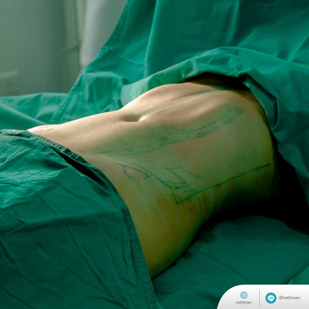 ดูดไขมัน เซ็กซี่ ไลน์ - sexy line liposuction เห็นผลทันทีหลังทำเสร็จ