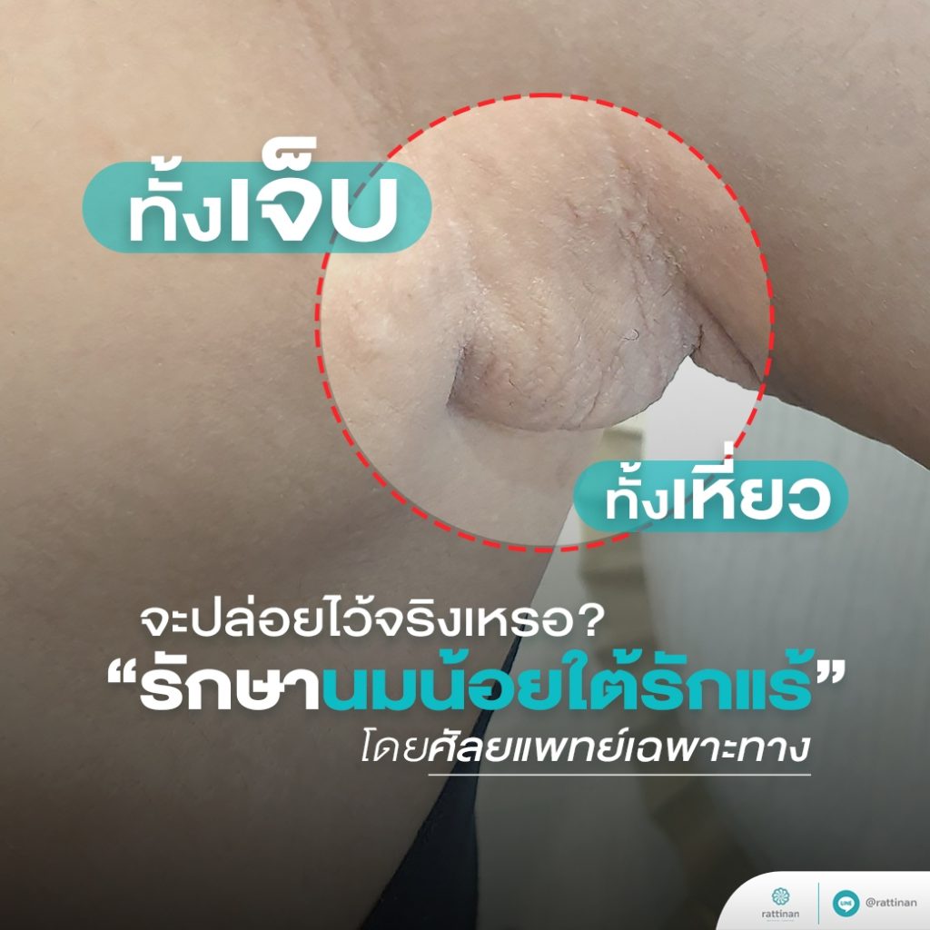 ไขมันใต้รักแร้ หรือนมน้อย รักษาด้วยการดูดไขมัน ตัดเนื้อเยื่อเต้านมออก