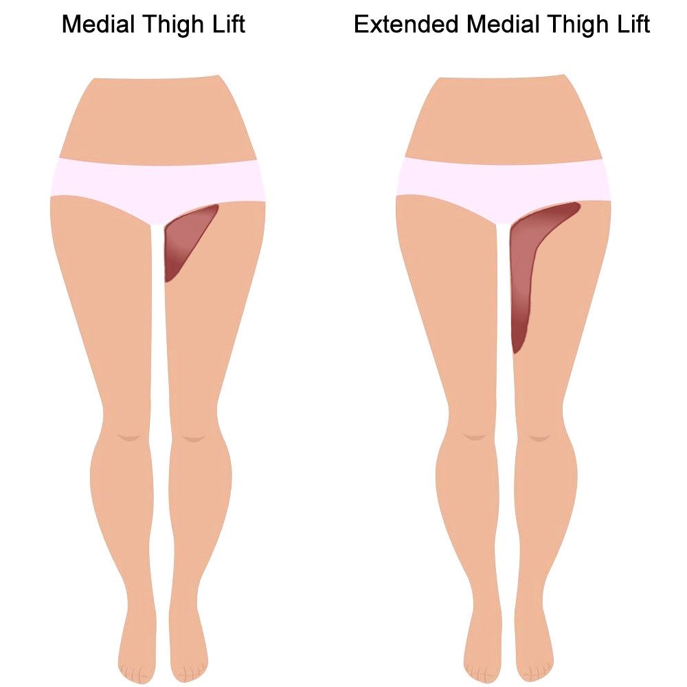 ดูดไขมันต้นขา ร่วมกับ การตัดหนัง (Liposuction & Thigh Lift) ทำอย่างไร จุดไหนบ้าง