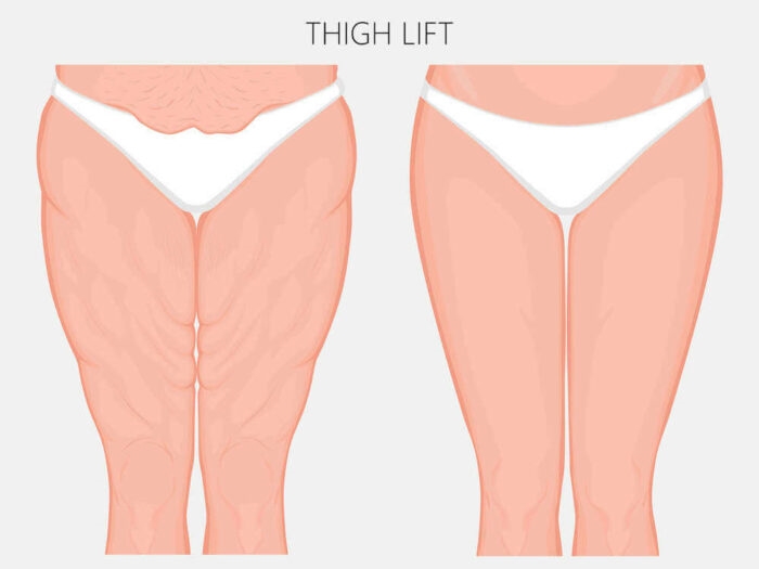 ดูดไขมันต้นขา ร่วมกับ การตัดหนัง (Liposuction & Thigh Lift)