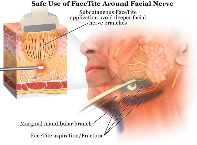 ดูดไขมันเหนียง ไขมันใต้คาง ด้วยเทคนิค NeckTite