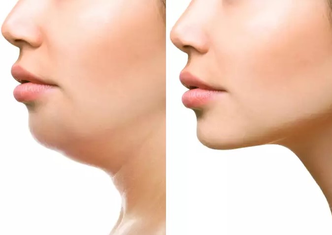 ดูดไขมันเหนียง (chin liposuction) ลดไขมันใต้คาง คางสองชั้น